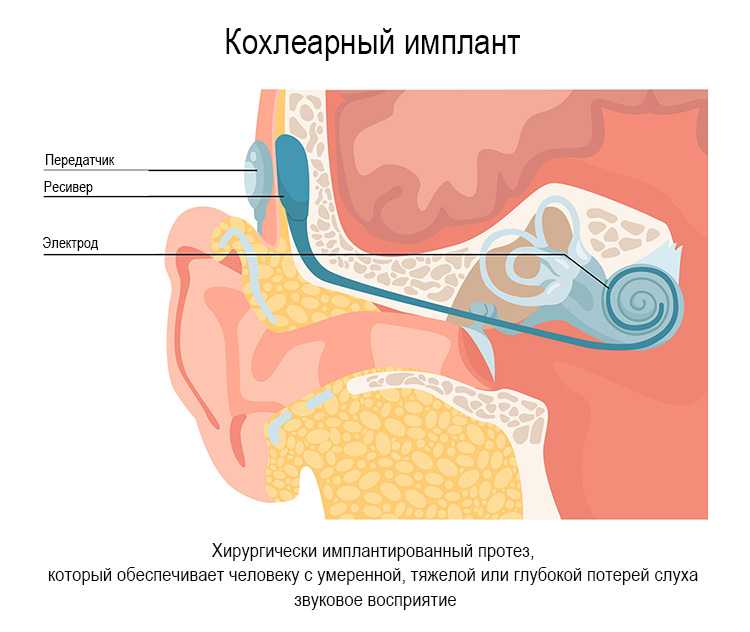 Изображение составляющих частей кохлеарного импланта